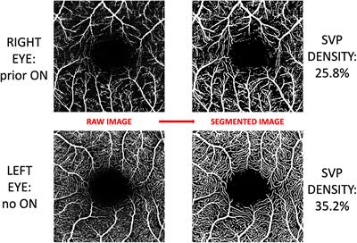 Optical Coherence Tomography and Optical Coherence Tomography Angiography Findings After Optic Neuritis in Multiple Sclerosis